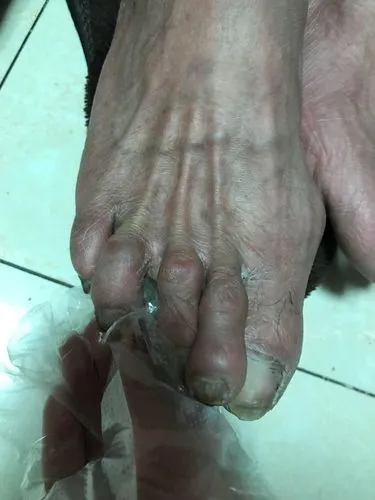 脚气是指甚么(图1)