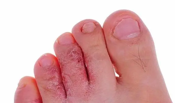 鳞屑角化型足癣脚底脱皮结痂图-有来大夫(图1)