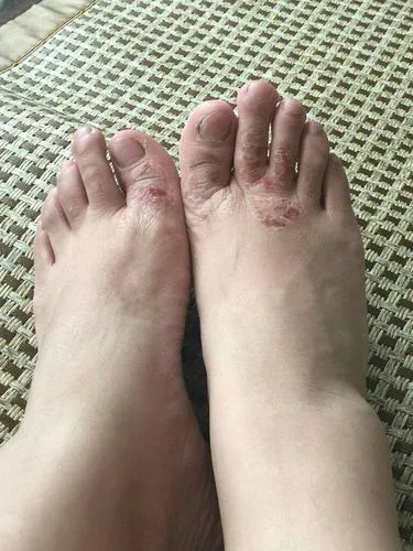 脚气患者需求留意些甚么(图1)