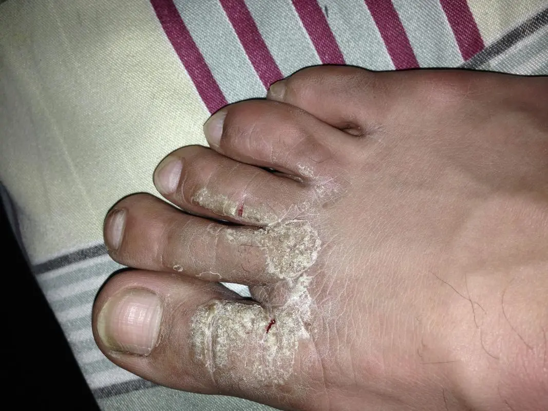 为何脚气越挠越痒-有来大夫(图1)