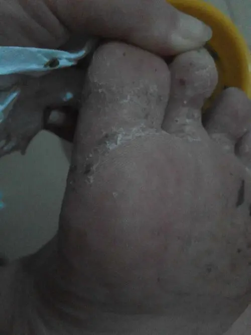 足藓拖着不治 小缺点惹起大费事(图1)