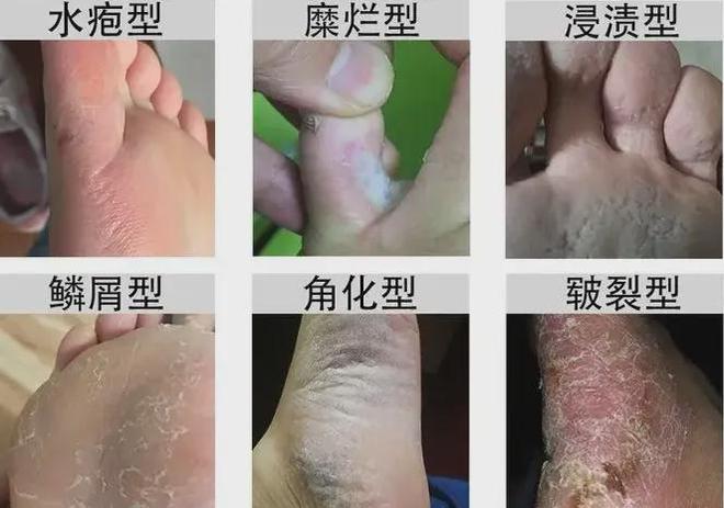 双脚有这5个病症多是疾病收回的旌旗灯号！