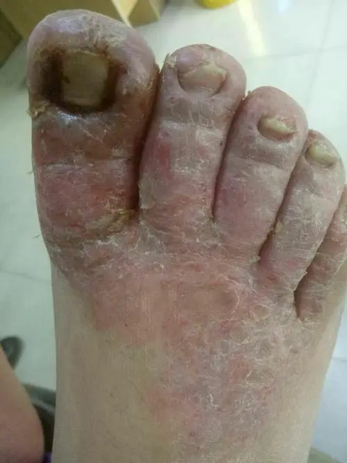 脚气图片下载(图1)