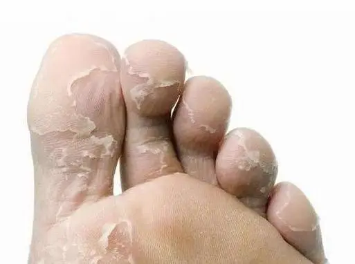 脚麻、脚根痛多是疾病预警旌旗灯号 双脚呈现这5个病症要留意