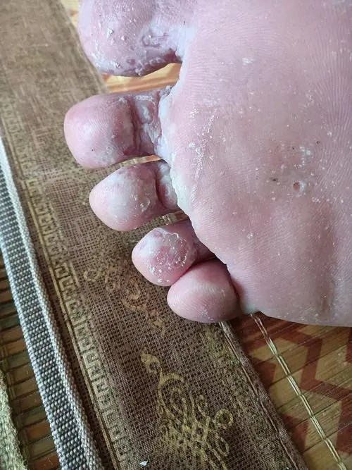 脚气是什么模样的(图1)