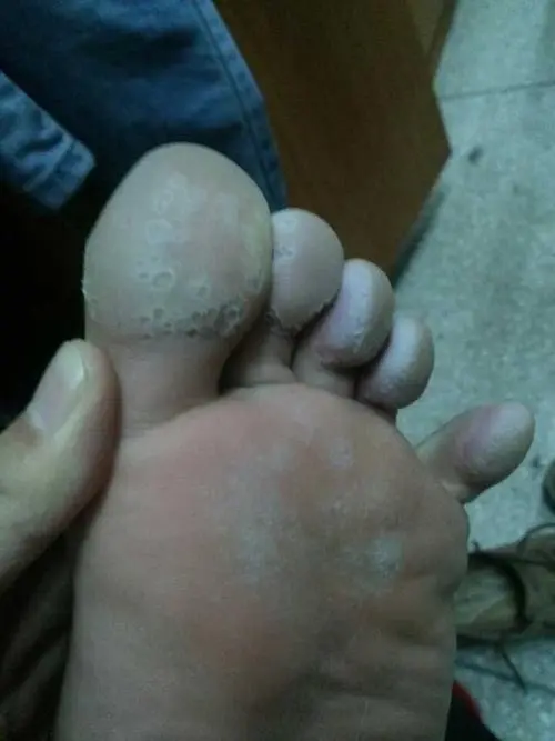 怎样处理脚气的痒