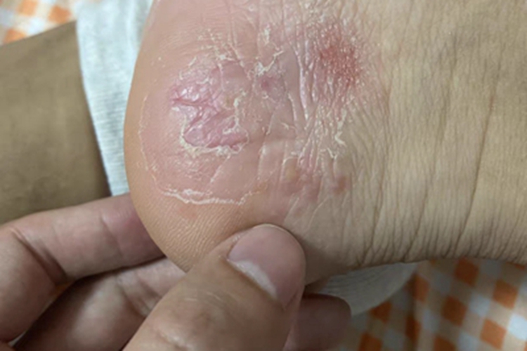 脚气重且穿鞋不适的缘故原由是什么