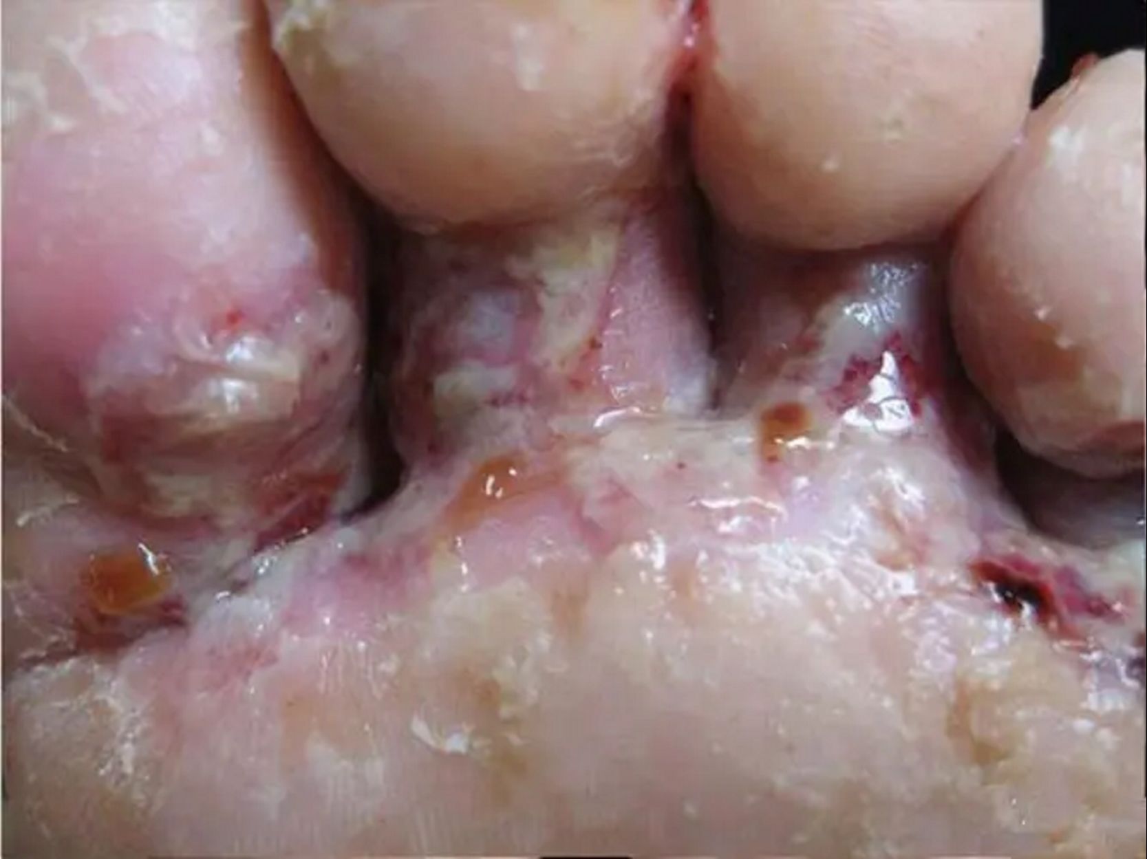 怎样治脚气脚指缝腐败