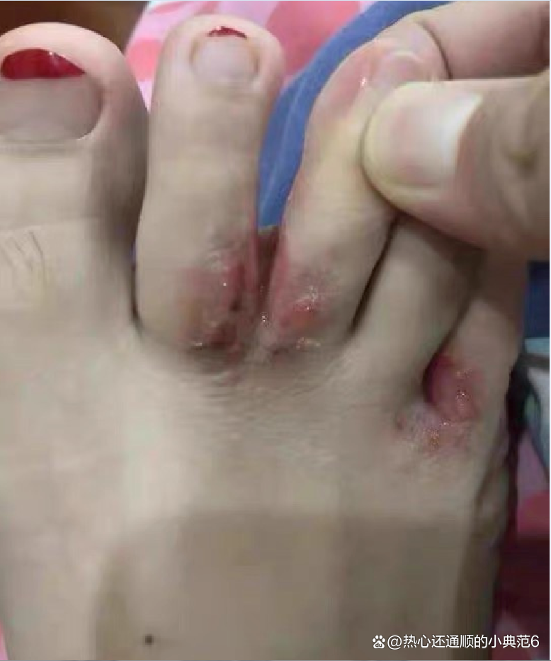 脚气与湿疹区分