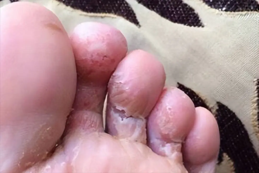 糜烂型脚气严峻吗
