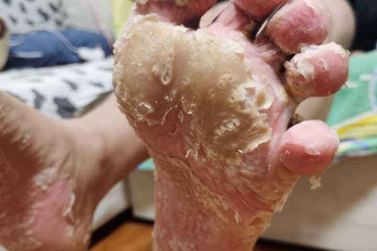 什么是脚气的早期病症