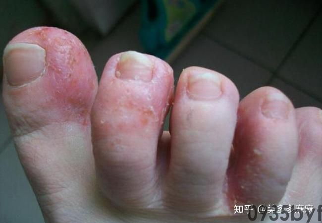 糜烂型脚气是怎么引起的
