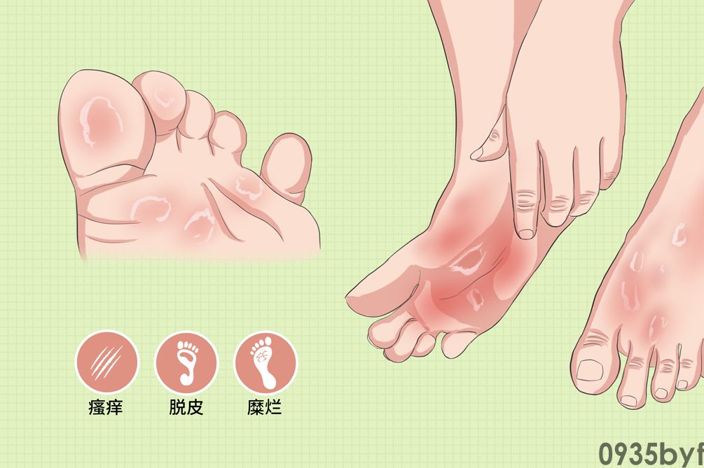 治脚气最简单有效的方法(图1)
