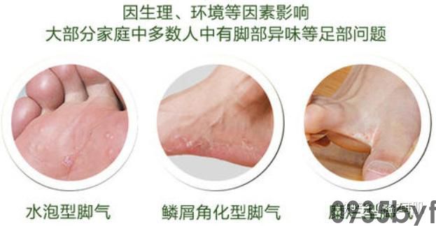 脚气开始脱皮是好了吗