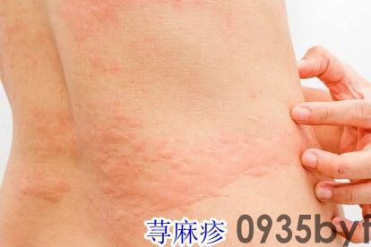 长荨麻疹有红斑怎么办