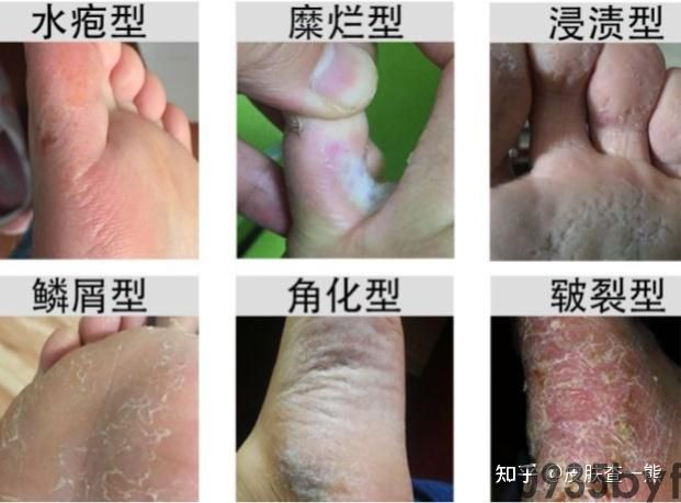 糜烂型脚气用药