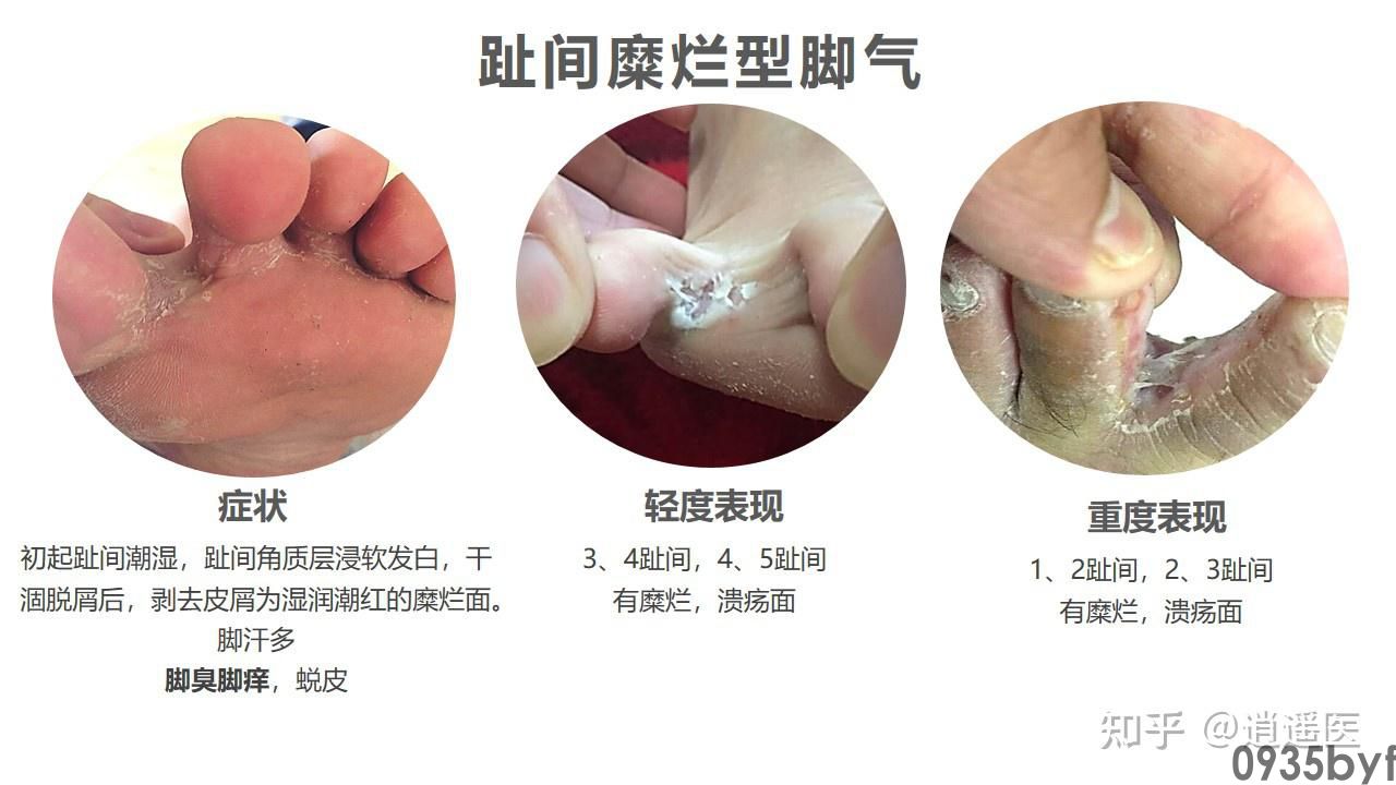 糜烂型脚气的临床表现-有来医生