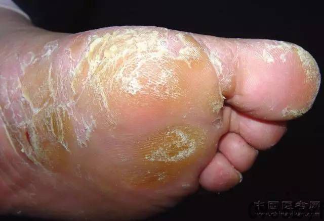 浸渍糜烂型足癣