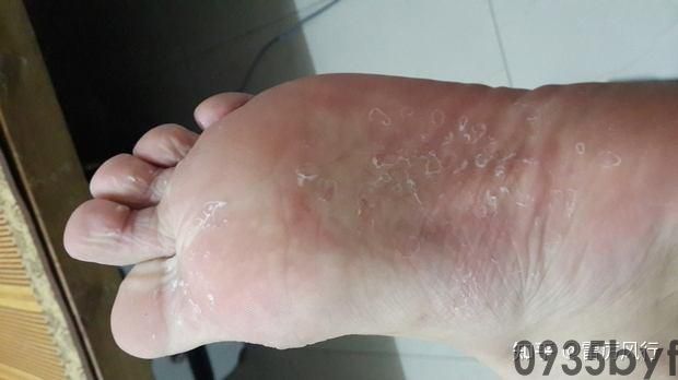 脚气症状图片