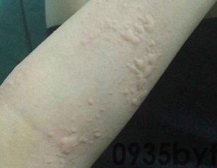皮肤性病科图谱