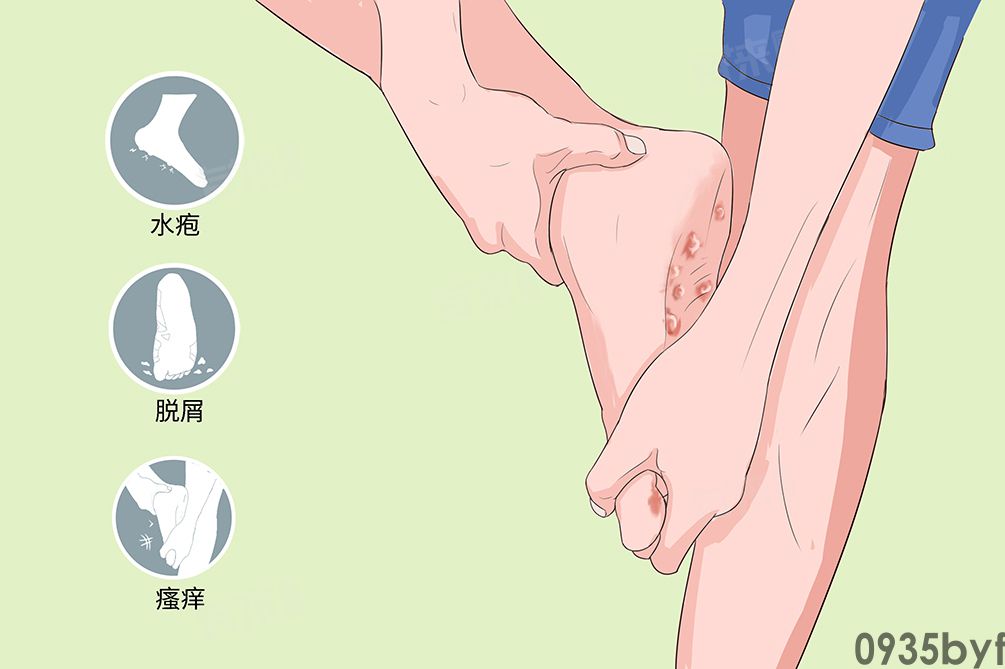 水泡脚气的症状(图1)