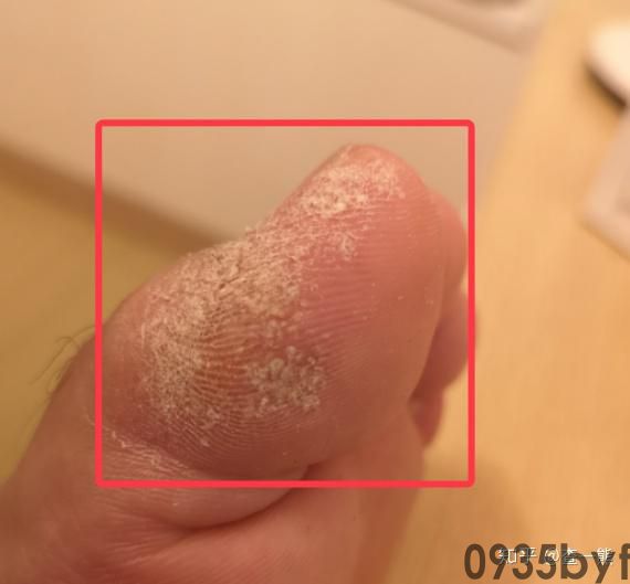 鳞屑型脚气