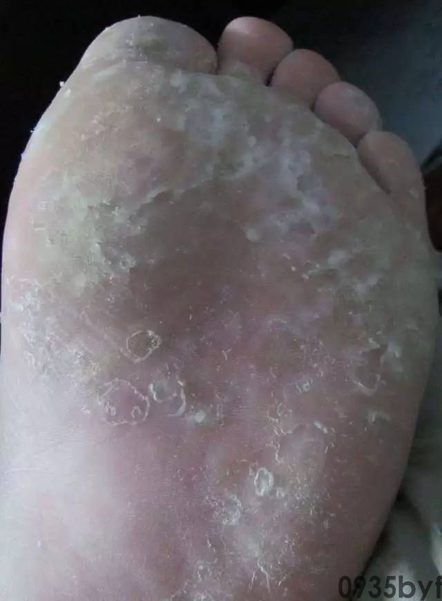 脚气脚糜烂很严重怎么办？