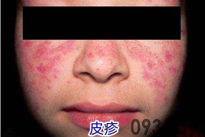 系统性红斑狼疮早期症状图片(图1)