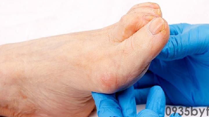 脚气有什么症状有哪些(图1) 脚气有什么症状有哪些