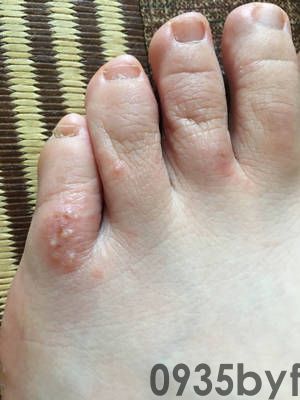 什么治脚气脚臭效果好