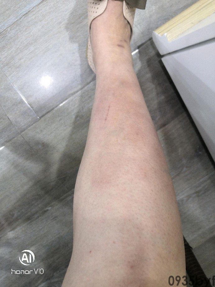 脚底出现红斑怎么回事