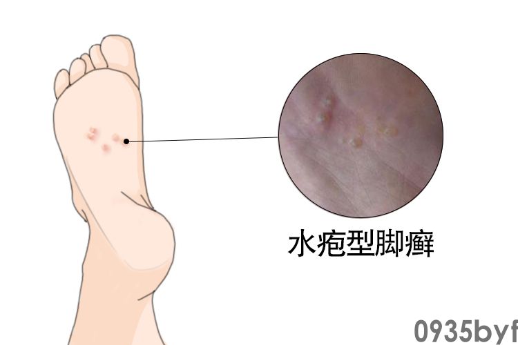 脚上起癣有几种图片及4种类型脚癣图片和症状(图1)