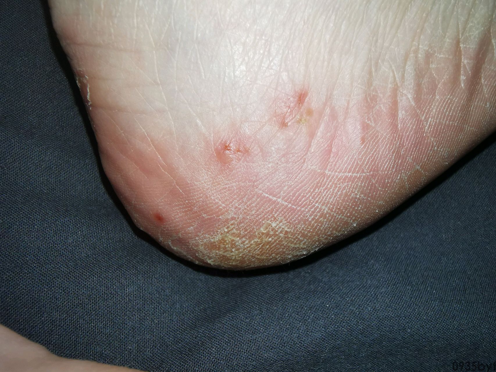 脚气的味道酸酸的为什么会这样怎么治?(图1) 脚气的味道酸酸的为什么会这样怎么治?