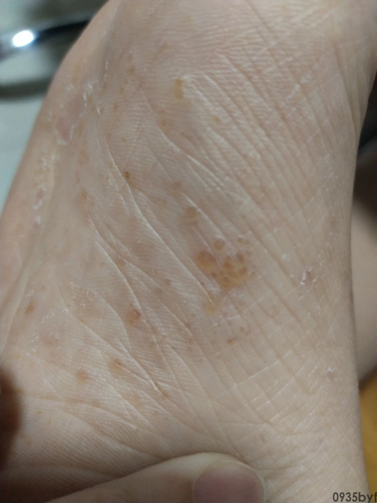 水疱型足癣怎么治疗