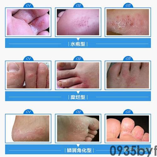 趾间糜烂型脚气怎么治