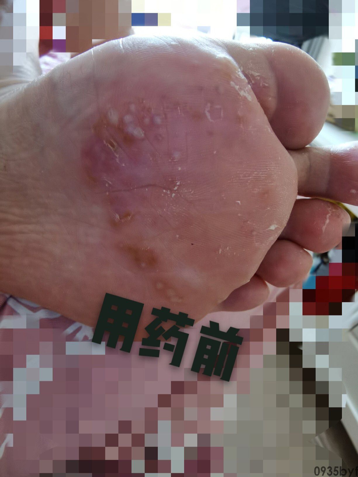 水泡型脚气