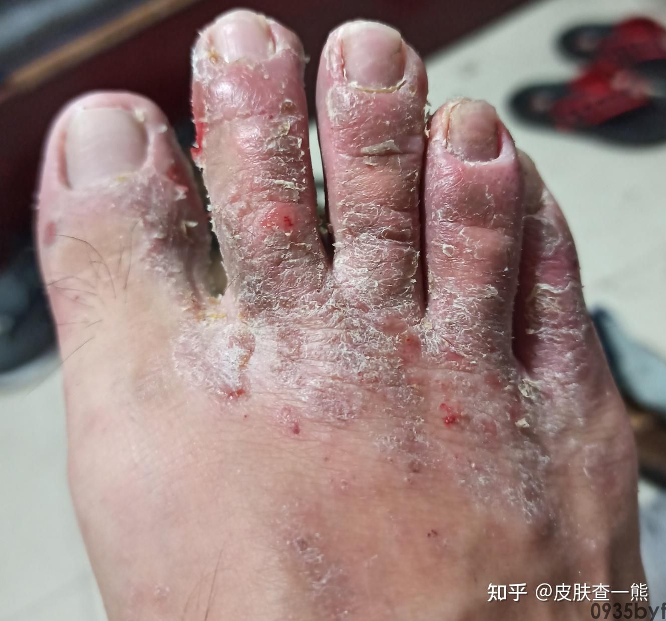 糜烂型脚气的症状表现是怎样的