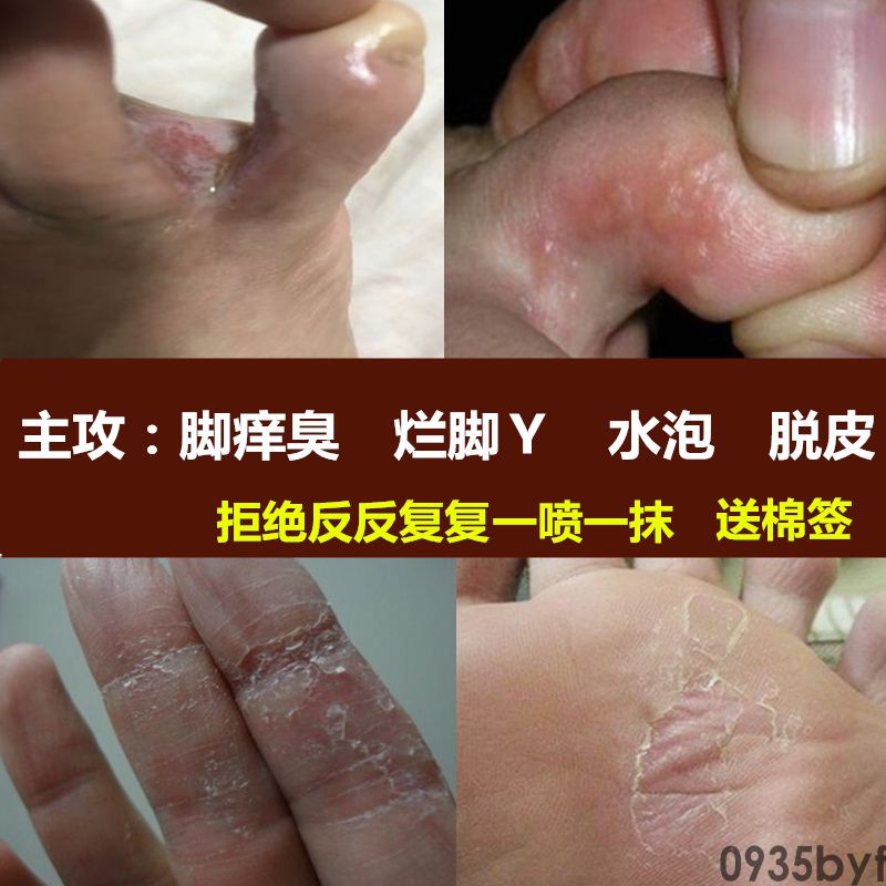 【图】什么叫水疱型脚气