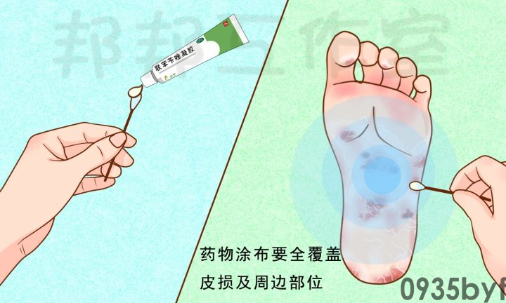 脚气患者需要注意些什么(图1) 脚气患者需要注意些什么