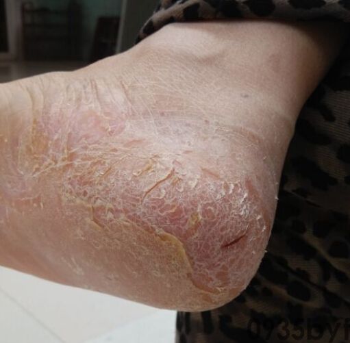 鳞屑角化型脚癣有什么好办法治愈(图1) 鳞屑角化型脚癣有什么好办法治愈