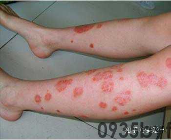 红斑丘疹鳞屑性皮肤病是怎样的?(图1) 红斑丘疹鳞屑性皮肤病是怎样的?