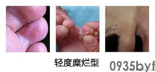 浸渍糜烂型足癣用什么药(图1) 浸渍糜烂型足癣用什么药