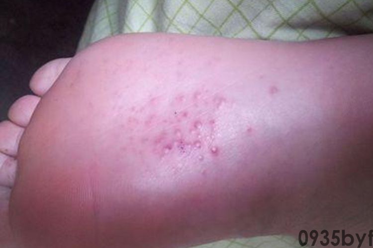 脚气初期图片_有来医生(图1) 脚气初期图片_有来医生(图1)