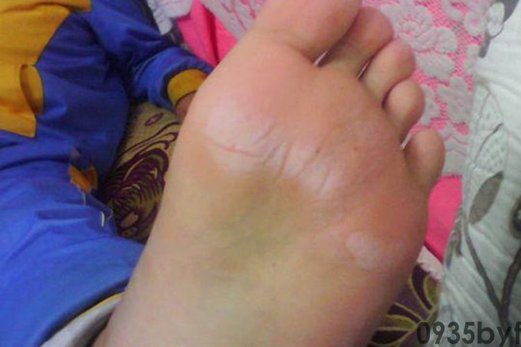 脚气初期图片_有来医生(图3) 脚气初期图片_有来医生(图3)