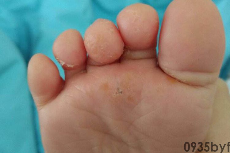 脚气初期图片_有来医生(图2) 脚气初期图片_有来医生(图2)