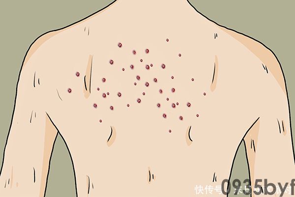 红斑丘疹怎么办-有来医生(图1) 红斑丘疹怎么办-有来医生