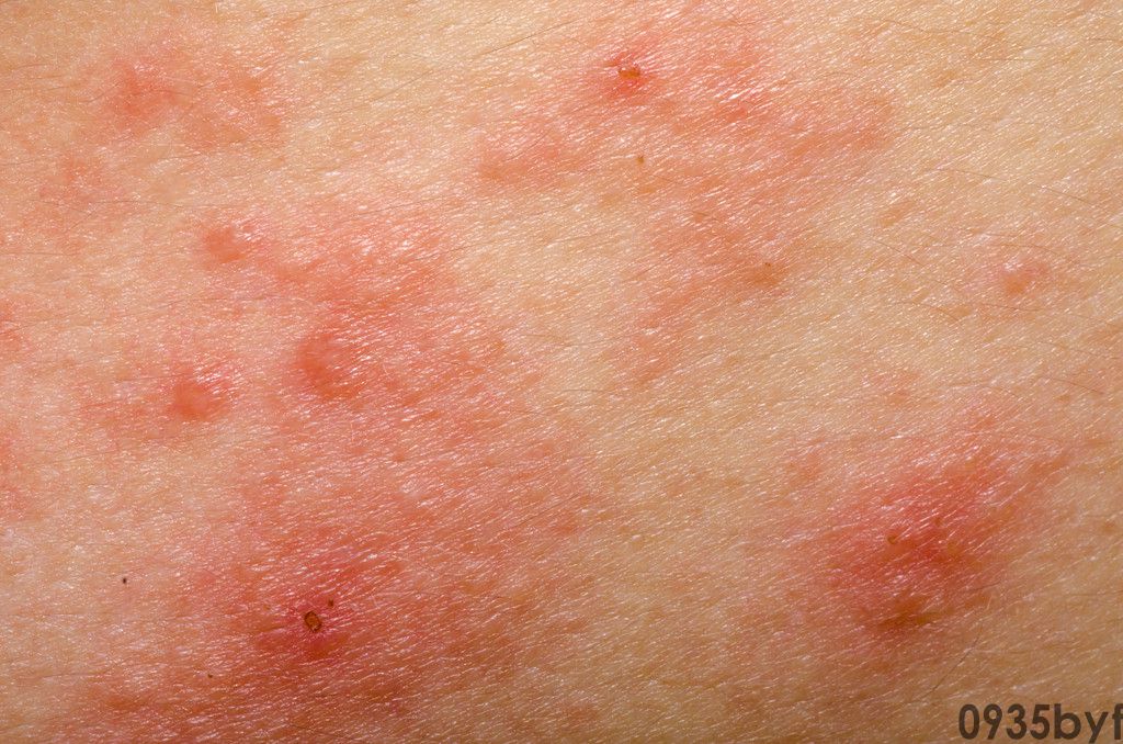 脚气的分类有哪些?(图1) 脚气的分类有哪些?