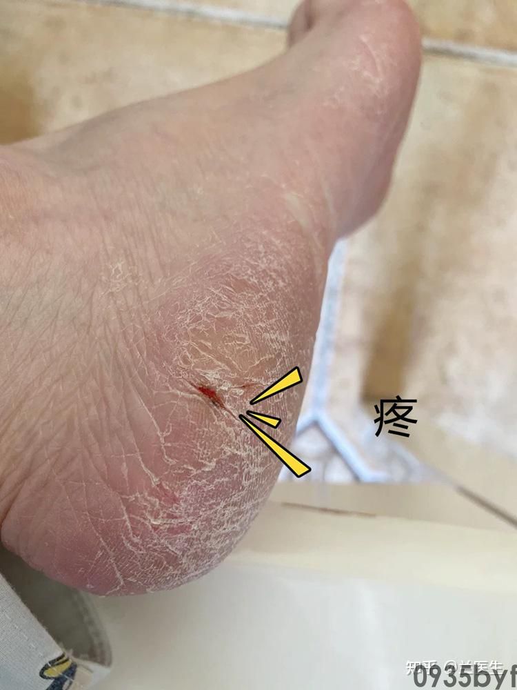 如何治疗脚气脚痒脱皮(图1) 如何治疗脚气脚痒脱皮