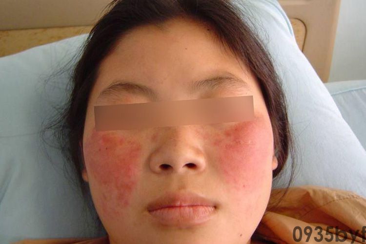 脚气有哪些方法可以治(图1) 脚气有哪些方法可以治