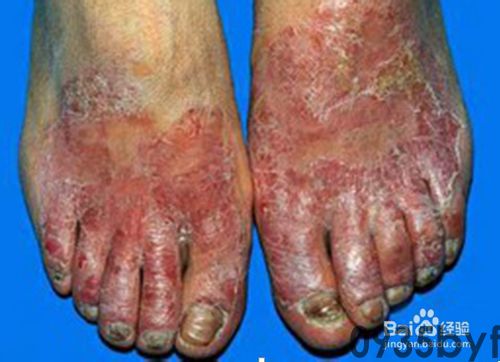 角化型脚气会不会传染(图1) 角化型脚气会不会传染